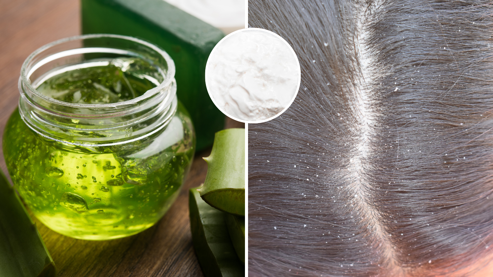 What is the easy way to clear dandruff? Content creator Ishika told the indigenous solution of curd and aloe vera, the scalp will be clean.